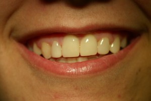 Carillas dentales en Clínicas Verdi