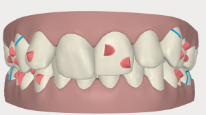 Invisalign ortodoncia invisible