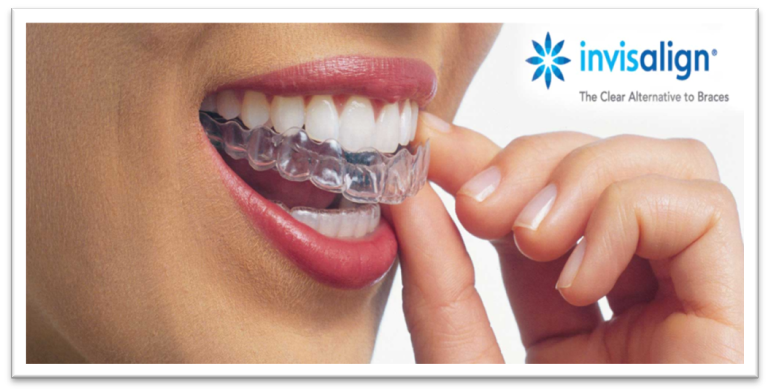 Invisalign - Clinicas Verdi